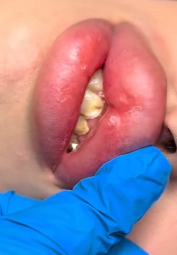 Для запису 0800330305 #стоматологіячеркаси #стоматологчеркаси #stomatologcherkassy #збільшеннягубльвів #косметологчеркаси 