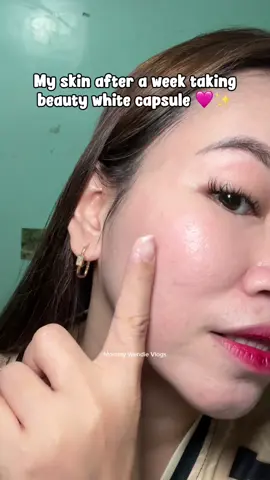 Breakout malala tlaga pero mabuti nalang may Beauty White Capsule ni You Glow Babe! #mommywendievlogs #beautywhitecapsule #ygb 
