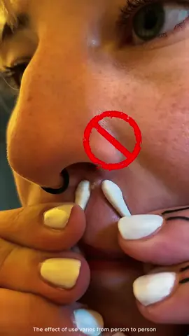 Acne gone in just 12 hours? 👀✨ Y.O.U Hy! Amino Ac-Ttack fights breakouts fast while keeping your skin soft and hydrated 💧 No more redness. No more stress. Just clear, calm skin 💕 Grab yours now during the Double 11 Sale! #clearskinin7days #AcneFreeSkin #Double11Deals #TikTokMadeMeBuyIt