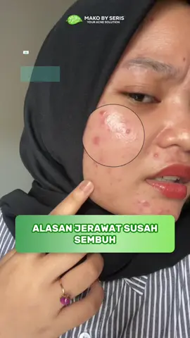 banyak alasan jerawat kamu susah sembuh, mungkin ini beberapa sebabnya:  #acnefighter #acneproneskin #acneskincare #skincarelokal #MakoBySeris 