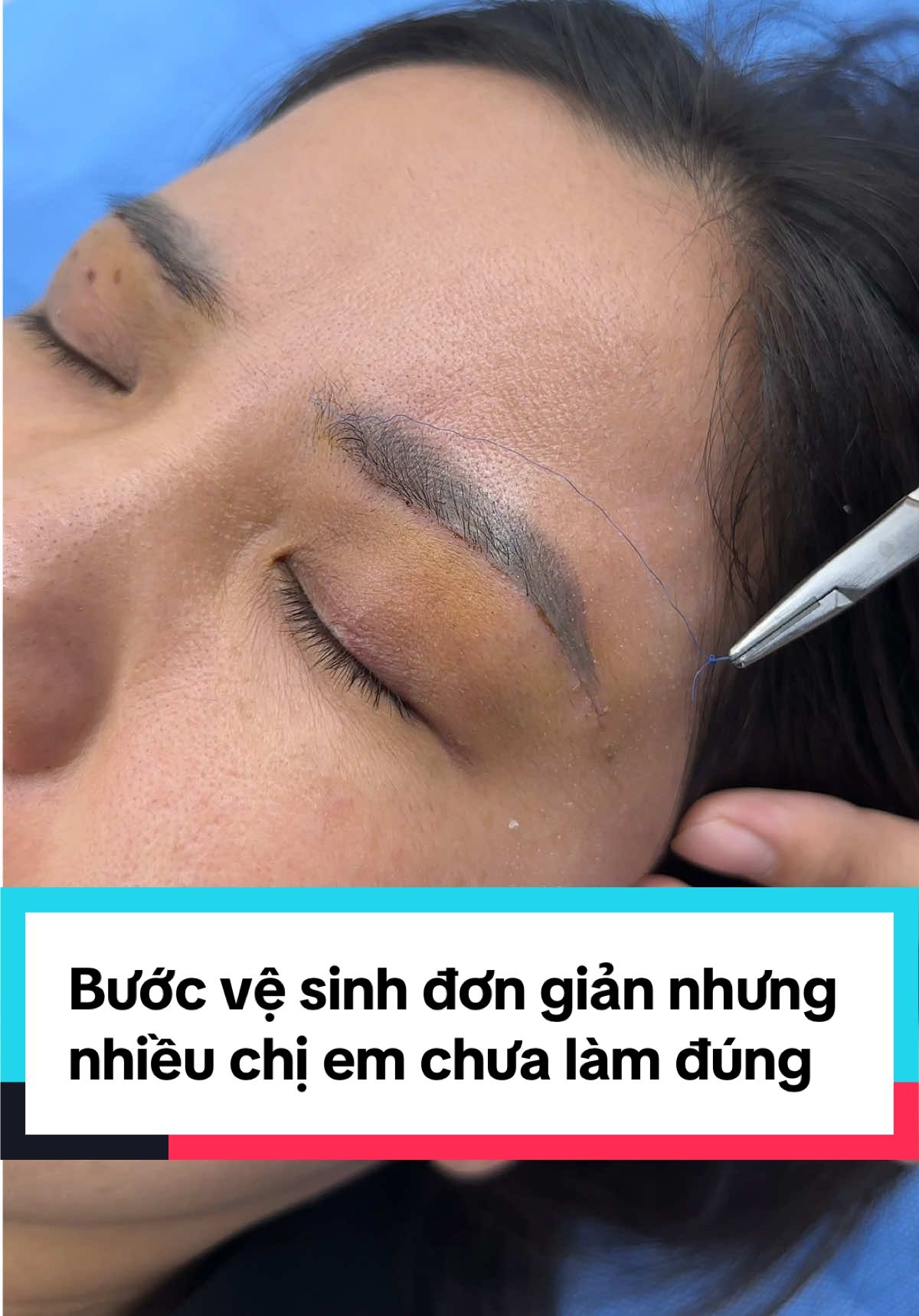 Nâng cung rút chỉ sau 7 ngày #nangcungchanmay #nangcungchanmayrutchi #nangcungmay #xuhuong #ilovetiktok 