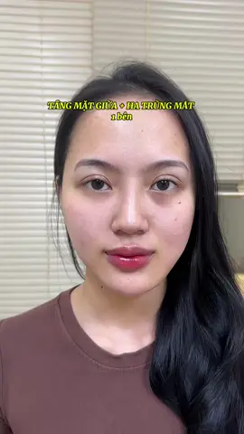 Combo tầng mặt giữa và HA trũng mắt cho khách yêu 💕 #dmanh #filler #botox 