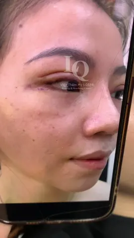 Cập nhật da sạm #chamsocdamun#chamsocdaseo#chamsocdanam#tanbinh#Lqspa&academy