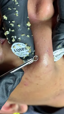 Nè #chamsocdamun#chamsocdaseo#chamsocdanam#tanbinh#Lqspa&academy