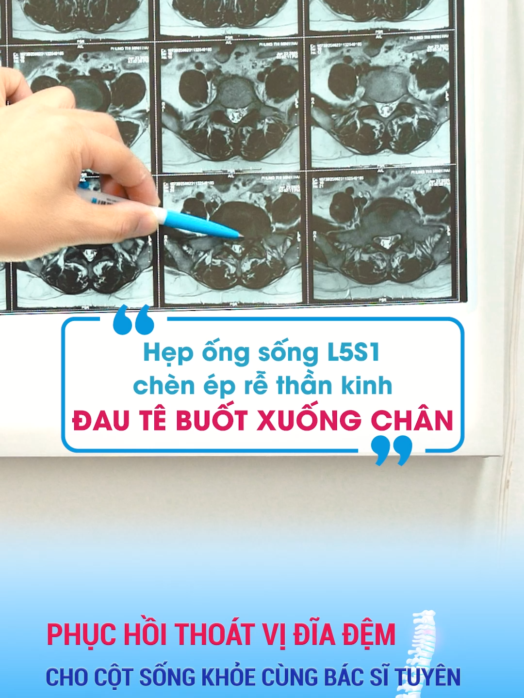 Hẹp ống sống L5S1 chèn ép rễ thần kinh, đau tê buốt xuống chân, đi lại khó #bstuyen #thoatvidiadem #cotsong #daulung #dieutrithoatvidiadem #tiemphongbe #thoatvi #khambenh #LearnOnTikTok #viral #xuhuongtiktok