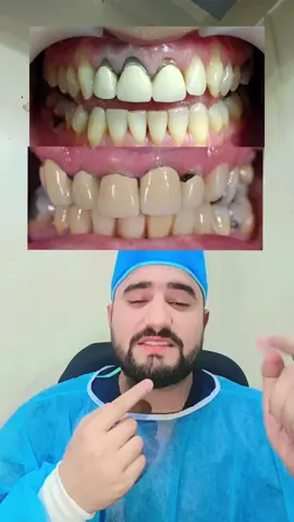 #creatorsearchinsights #zerconiacrown #dentalveneers #teethcare #foryoupage❤️❤️ 