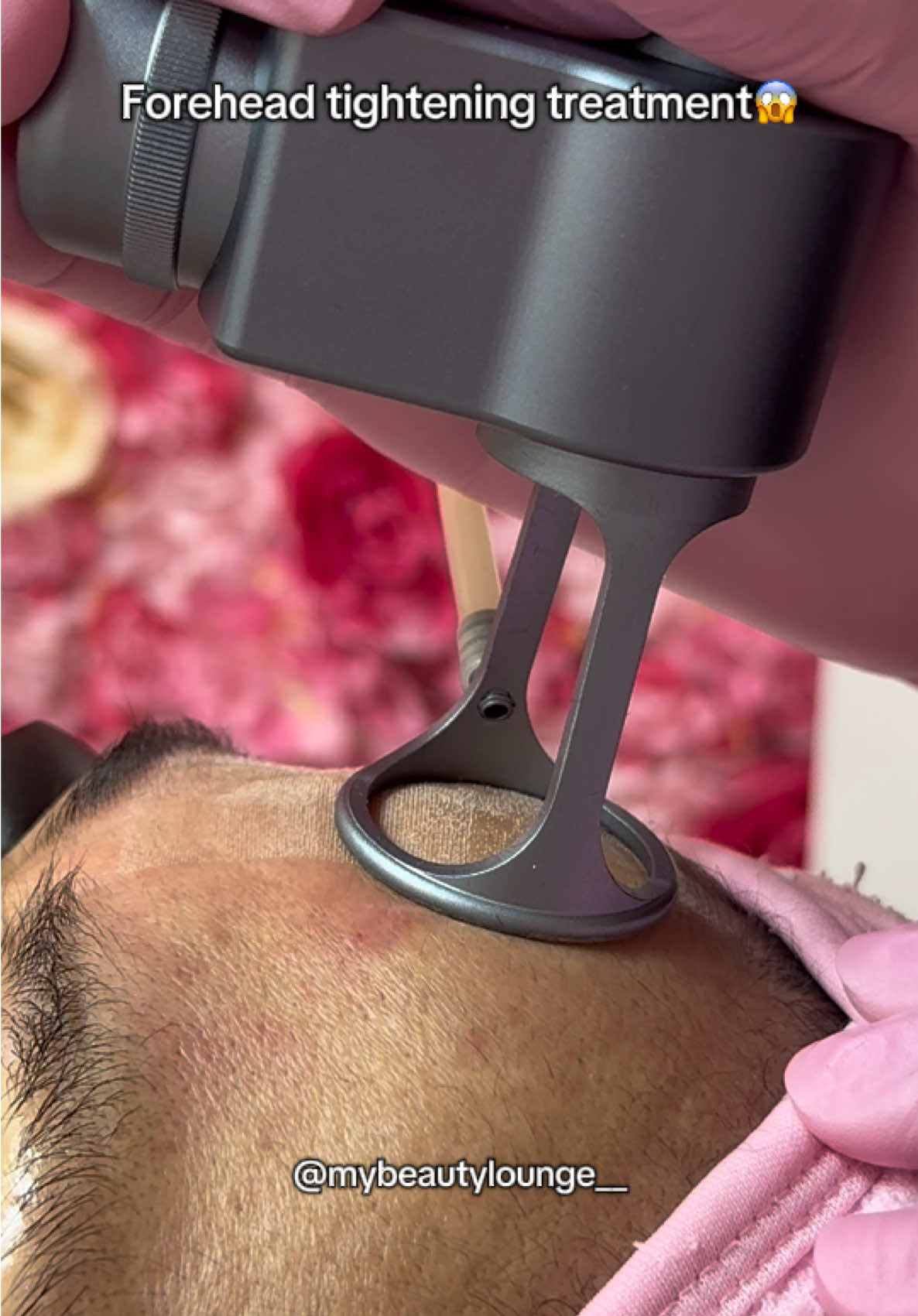 Have you had this treatment before? #co2laser #fractionallaser #skintightening #lasertreatment 