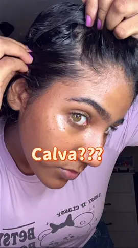 😱 ¡Estoy quedando calva! Pero descubrí un producto que está haciendo milagros con mi cabello ✨💆‍♀️  #amazon #CaídaDelCabello #caidadecabello #HairCare #TikTokBeauty