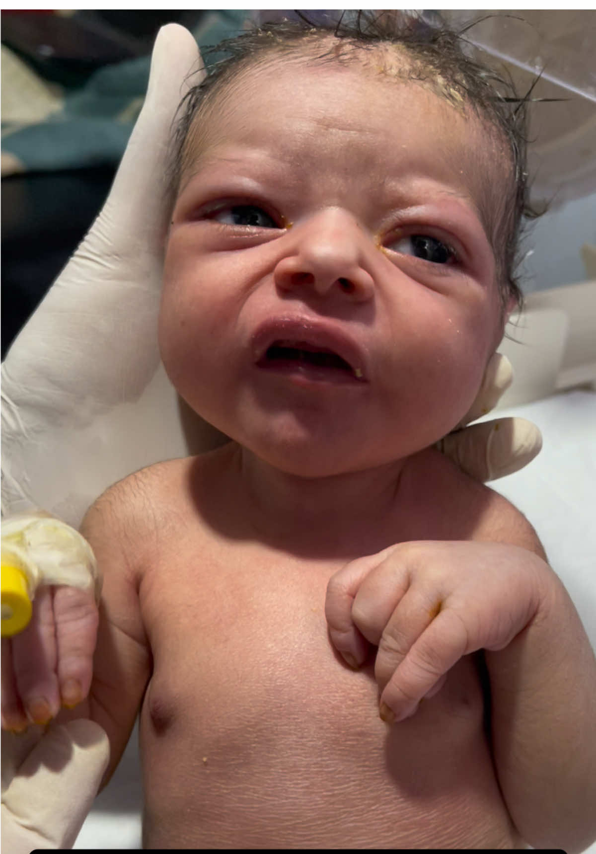 Newborn baby with yellow big nails😢💔 #nicubaby #nicubaby #drnadeem804 