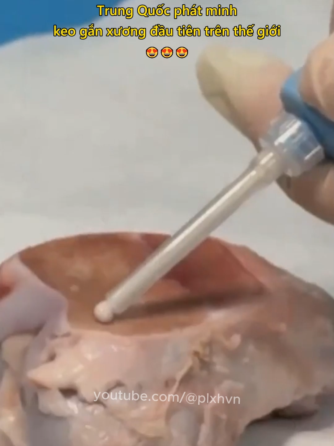 Trung Quốc phát minh keo gắn xương đầu tiên trên thế giới 😍 #yte #bacsi #phatminh #trungquoc #tintuc #plxhvn #phapluatxahoi