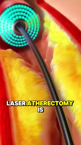 How Laser Atherectomy Procedure Is Performed - 3D Animation) Watch how doctors use laser energy to remove hardened plaque from blocked arteries, restoring smooth blood flow and preventing heart complications. #LaserAtherectomy #HeartTreatment #Medical3D #Cardiology #ArteryCleaning