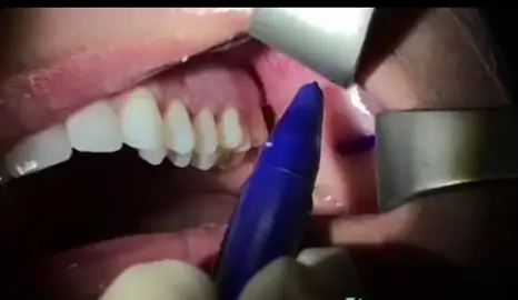 استئصال كتلة بيشا #سامرعقاد #طبيب_اسنان #dentist  #samerakkad #tandläkare 