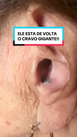 CRAVO GIGANTE!  Ele está de volta 😮‍💨😮‍💨 #cravoseespinhas #cravos #cravosgigantes 