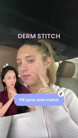 when you don’t have acne, but it looks like you do 😩 leave your questions in the comments 👇🏼 #dermatologist #skincaretips #pie #redness 