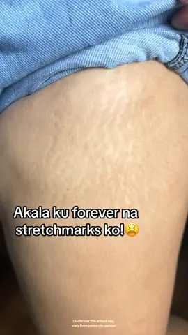 Holy Grail!✨🫶#fyp #stretchmarkremoval #stretchmarks #stretchmark #organicskin 