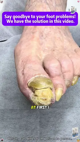 Say goodbye to nail fungus with this!#healthynails#resultsmayvary#antifungal#fungalnail#NQT