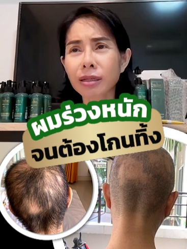✨ซึมเศร้าเป็นปี...จนต้องโกนผมทิ้ง‼️ผมร่วงเป็นหย่อม ไม่คิดไม่ฝันว่าจะหนาขึ้นได้ขนาดนี้...⁉️ . ✨คุณนัส มนทิพย์ หงษ์กลาย มีปัญหาผมร่วงเป็นหย่อมรุนแรง จนต้องโกนผมทิ้ง  ทำให้ทุกข์ใจอยู่เป็นปี ๆ ไม่กล้าออกไปไหนจนมีภาวะซึมเศร้า . ✨ก่อนที่ชีวิตจะพลิกจากร้ายกลายเป็นดี เมื่อได้เจอกับฮาวิล่าห์ โดยเคสคุณนัสได้ อ.ป๋อง แก้ปัญหาผมร่วง ผมบาง เจ้าของแบรนด์ฮาวิล่าห์ ช่วยดูแลพร้อมให้คำปรึกษา โดยแนะนำให้คุณนัสให้ใช้แชมพูลดผมร่วงกับแฮร์โทนิคปลูกผม . ✨ผลลัพธ์หลังใช้อย่างต่อเนื่อง ประมาณ 3-4 เดือน เส้นผมของคุณนัสก็มีผมขึ้นมาใหม่ ผ่านไป 1 ปี ผมก็ยาวและหนาขึ้นอย่างเห็นได้ชัด ไม่ต้องทุกข์ใจอีกต่อไป รู้สึกขอบคุณฮาวิล่าห์มาก (นี่คือเรื่องจริงจากใจของคุณนัส) . #Havilah #ฮาวิล่าห์ #ผมร่วง #ผมบาง #ผมสวย #บำรุงผม #แชมพูลดผมร่วง #รักษาผมร่วง #แชมพูสมุนไพร