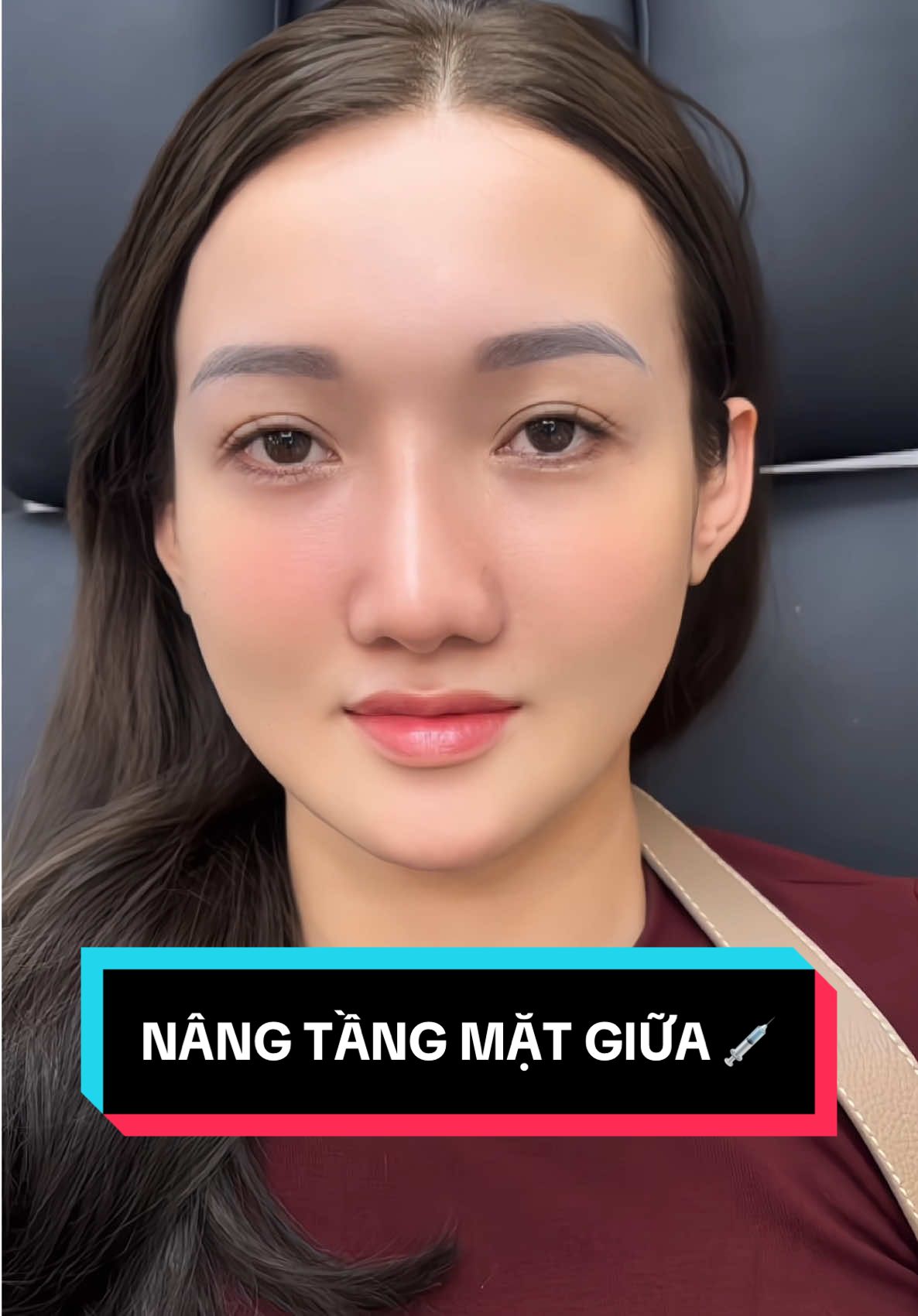 ✨Top dịch vụ khiến gương mặt chị em từ chảy xệ sang đầy đặn trẻ trung vài tuổi thì không nên bỏ qua tiêm nâng tầng mặt giữa 💉 #TienLeAcademy #filler #tienleacadamy #botox #nâng_tầng_mặt_giữa 