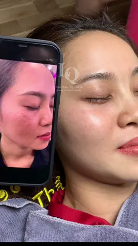 Cập nhật da nám #chamsocdamun#chamsocdaseo#chamsocdanam#tanbinh#Lqspa 