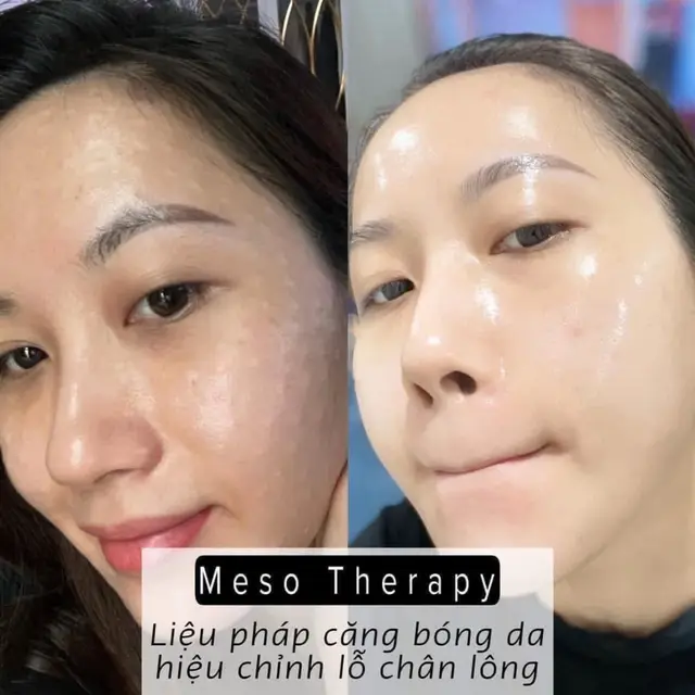 Mỹ phẩm có thể ko hấp thụ . Ko hợp. Chứ cấy meso dưỡng chất là hấp thụ hết lun nè #thammyantoan #xuhuongtiktok #mesotherapy 