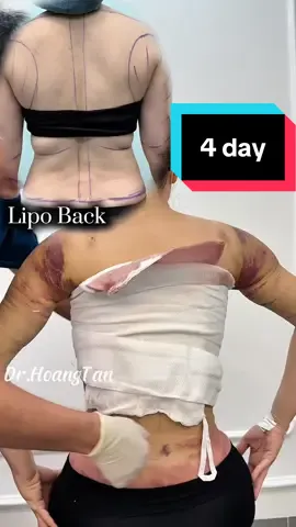 Part 57| 4 day  #backliposuction #lipo360 #beforeafter #backlipo #lipo 