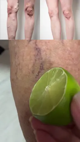 🍋 El truco casero que borra las várices en 3 días 😱🦵 #varices #remedioscaseros #salud #bellezanatural #cuidadodelapiel #remediosnaturales #café #limón #fyp #parati 