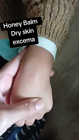 #dryskin #eczema #lipbalm #bodybalm 