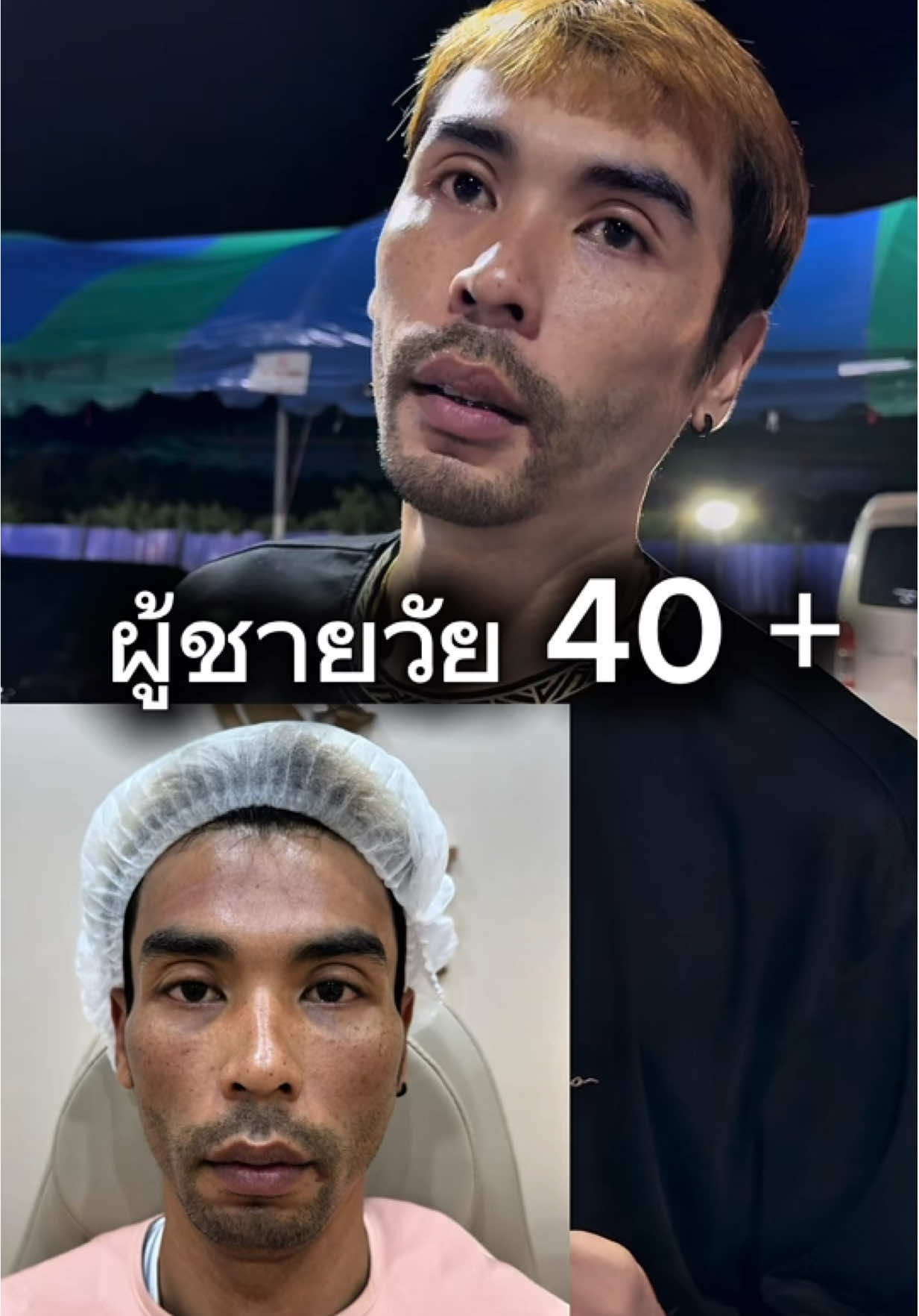 @Pondtech Benjarong #ปรับรูปหน้า #คลีนิกท่าข้าม #เติมฟิลเลอร์ #โมสเวลเนส @โมส ศัลยกรรม  @AuzyAIA #aor77 