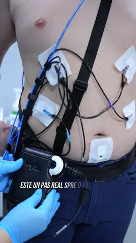 Scanează-ți sănătatea cu o simplă capsulă – în premieră la Spitalul Repromed O capsulă cât o pastilă schimbă complet felul în care privim medicina digestivă. Fără anestezie. Fără disconfort. Fără spitalizare. Doar o tehnologie care lucrează pentru pacient – simplu, sigur și precis. Endoscopia video cu capsulă nu e doar o metodă nouă, ci un mod diferit de a avea grijă de sănătate. În locul procedurilor invazive, pacientul înghite o capsulă inteligentă care surprinde imagini detaliate din interiorul tubului digestiv, permițând medicilor să depisteze cauze ascunse ale unor simptome precum anemia, durerile abdominale sau inflamațiile intestinale. Este diagnosticul viitorului, disponibil acum și la Spitalul Repromed. Iar pentru primele 10 investigații, oferim o reducere de 10%. Medicina modernă începe cu o capsulă mică. Dar impactul ei e uriaș. Pentru mai multe detalii și programări: 📞 022 955 500 | 🌐 www.repromed.md #repromed #capsula #endoscopie #video #pastila 