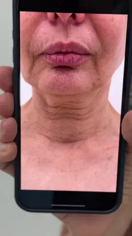 3 saptamani de la Facelift... #drlevymedicalcenter #plasticsurgeonsoftiktok #facelift 