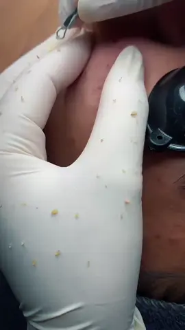 Gói gọn ca mụn ở đây ạ ❤️#lấynhanmunchuanykhoa #nặnmụn #spabienhoa #viral #xuhuong 