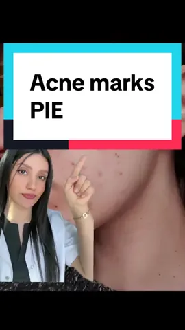 Azelaic acid is a gentle yet powerful treatment for fading acne marks, reducing redness, and preventing new breakouts. With consistent use and proper sun protection, it helps even out skin tone and improve texture without causing irritation—making it ideal for sensitive and acne-prone skin. #acnescars #acnemarks #postinflammatoryerythema #skintok 