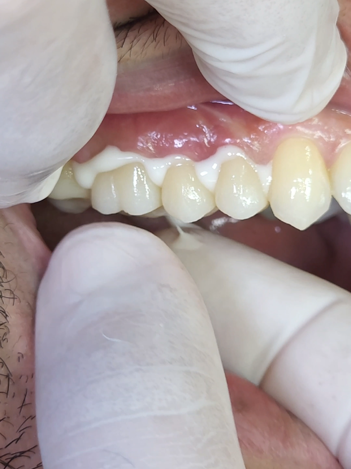 #LearnOnTikTok #طبيب_تيك_توك #fyp 