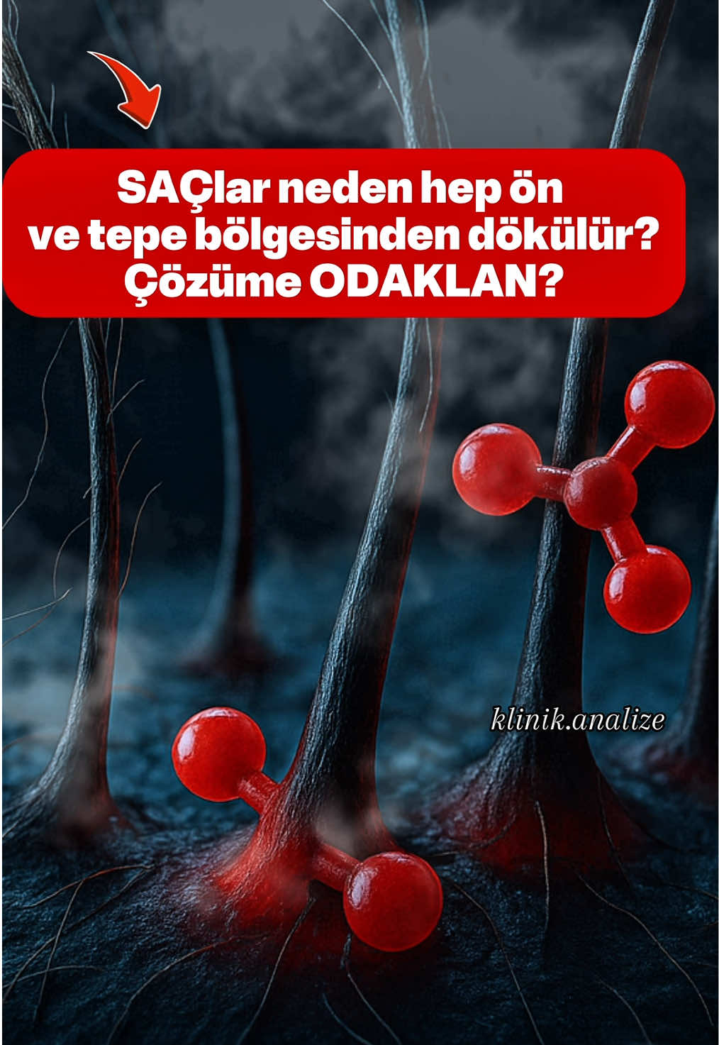 Ön ve tepe bölgesindeki dökülme genetik olarak yaygındır çünkü bu kökler DHT’ye %70–80 daha duyarlıdır. Dolaşım zayıfladığında kök yeterli oksijen ve besin alamaz, saç incelmeye başlar. Bu tablo geri döndürülebilir. DHT etkisini dengelemek için saw palmetto, beta-sitosterol ve pumpkin seed; dolaşımı güçlendirmek için ginseng, kafein ve niasinamid; hücre yenileme ve bariyer onarımı için panthenol, allantoin ve copper peptide birlikte kullanılır. Düzenli kullanımda kök dengesi yeniden kurulabilir. Yorumlara “kombinasyon” yazın, sizin için en uygun içerik oranını birlikte değerlendirelim. #saç #hairloss #hairgrowthtips #dht #klinik 