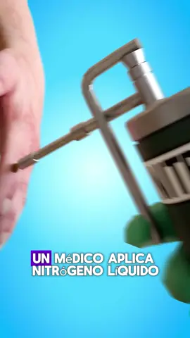 Eliminación de verrugas con nitrógeno líquido #curiosidades #interesante #datosintresantes #fyp #parati