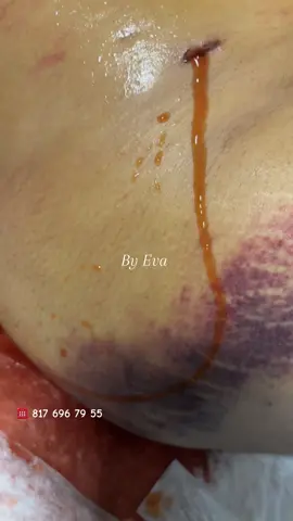 @Mobil lymphaticdrainagemassage 