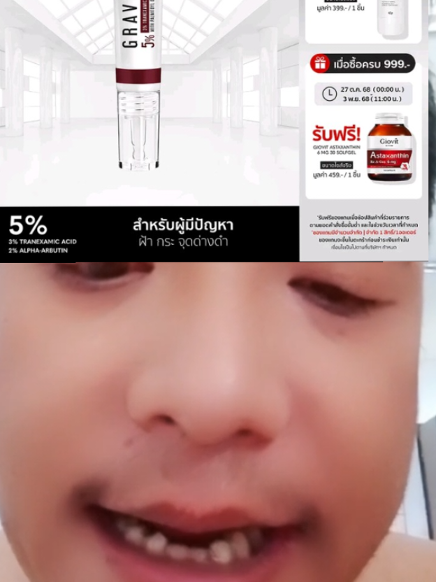 แต้มฝ้าตัวดัง ของ gravich บดฉ่ำมาก  #ครีมแต้มฝ้า #gravich #ฝ้ากระจุดด่างดําจางลง 