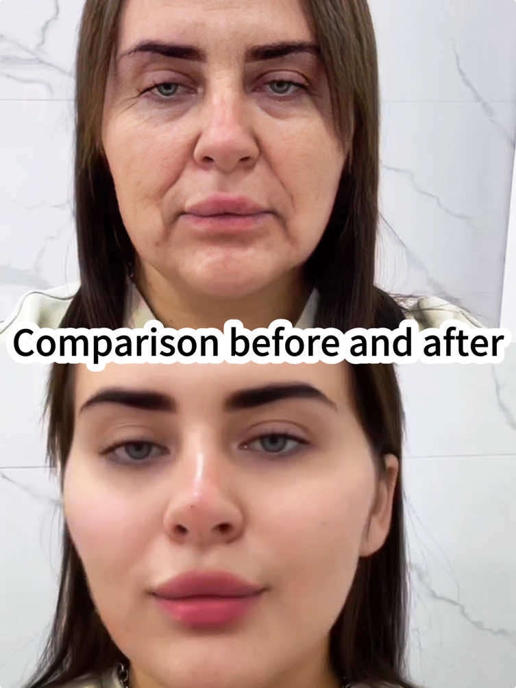 In the past, his face looked 10 years old, but now he is so tight that he shines✨ #facelift #antiaging #FacialAesthetics #getbetter #younger 