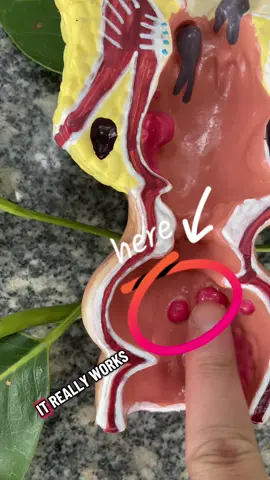 This is the ONLY thing that gave me real relief - and it's mess-free Comes with 4 clean applicators. No more pain, no more itch. #hemorrhoids #vamy #cream #SelfCare #hemorrhoidhelp