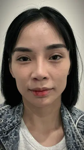 💎 CHỈ 799K – TIÊM CHUẨN MASTER, ĐẸP KHÔNG GÓC CHẾT! 💎 Cả list dịch vụ hot nhất 2025 đang đồng giá chỉ 799K nè 👇 ⸻ 💉 DỊCH VỤ HOT NHẤT ✨ Tiêm môi (Baby / Sexy / Cherry / Tây) ✨ Tiêm cằm Vline ✨ Tiêm thái dương đầy, cân khuôn mặt ✨ Tiêm Fullface MD Code – nâng tầng mặt táo ✨ Tiêm nâng cơ, treo cơ, trẻ hóa viền hàm ✨ Tiêm tai tài lộc – tai vểnh Trung Hoa, sửa khuyết điểm tai ✨ Tiêm xóa nhăn trán, cau mày, đuôi mắt ✨ Tiêm tan mỡ má – tan mỡ nọng – thắt cơ định hình Vline ✨ Tiêm trị thâm hốc mắt bằng vi bột tái sinh collagen ✨ Cấy chỉ trán – nâng siết cơ ✨ Trị hôi nách – khử mùi y khoa ✨ Má lúm tự nhiên – không sẹo, không đau ✨ Mũi chỉ siêu cấu trúc / mũi sụn Surgi cao tây ✨ Sửa mí – sửa mũi lỗi – treo cung – cắt môi – tân trang vùng kín 🎀 Tất cả đều được bác sĩ kiểm tra & Master trực tiếp thực hiện ⸻ 💎 ƯU ĐÃI ĐẶC BIỆT 💉 Master trực tiếp tiêm – chuẩn y khoa 💎 Kiểm tra thuốc, test tan minh bạch 🌸 Bảo hành như khách VIP 🔥 Giá chỉ 799K – không phát sinh ⸻ 📍 TP.HCM – Bảo Lộc 📞 0353 011 186 ⏰ Chỉ 10 slot / tuần – book sớm kẻo hết nha!