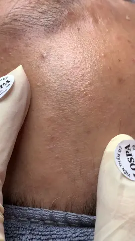 Nhẹ #chamsocdamun#chamsocdaseo#chamsocdanam#tanbinh#Lqspa&academy