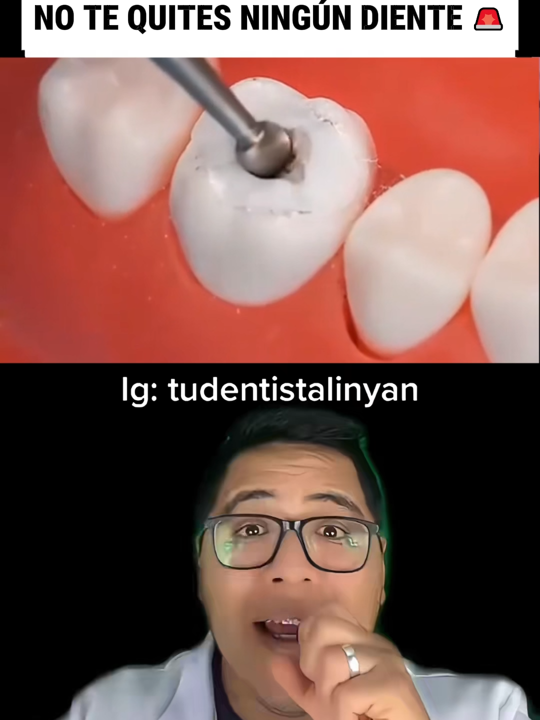 Mantenga sus dientes sanos!#toothpaste #teethcare #Toothdecay #toothpaste #Dentalcaries #Dentalcaries #Dentalcare# dientes # dientes#Gingivitis #Oralbacteria #DentalHealth #tiktokshopholidayh#sp8 #astraglows