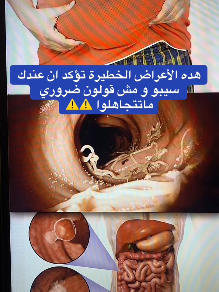 #قولون_هضمي #إمساك #خمول #93saudinationalday #إنتفاخ_القولون #الرياض_الآن🇸🇦🇸🇦 #مكة_المكرمة_السعودية #قولون_معدة_غازات_إنتفاخات_إمساك_حموضة #الدمام #الرياض_جده_مكه_الدمام_المدينه #السعودية_الكويت #توعية_صحية #الرياض_الان #إمساك_مزمن #قولون #قولون_تقرحي #إرتجاع_المرئ #إنتفاخ_البطن_والأمعاء #إنتفاخ_البطن