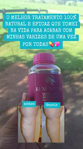 O Melhor tratamento natural que ja usei para varizes💊💖🔥 . .  #vasinhos #varizes #AntesEDepois #PernasLeves #varizesnuncamais 