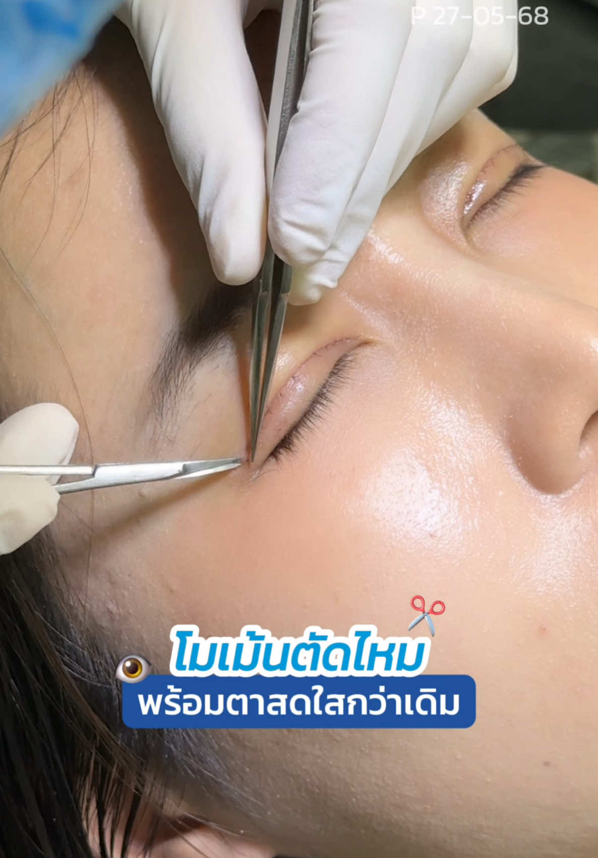 ครบ 7 วันตัดไหม #ตาสองชัิน พร้อมชัินตาใหม่สวยกว่าเดิม 👁️✨ #skyclinic #จักษุแพทย์ #หมอสกาย #ทําตาที่ไหนดี 