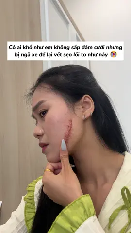 Sắp đám cưới mà bị sẹo lồi như này thì dùng ngay Actiscar thôi. #actiscar #moseotainha #kemmoseo #triseo 