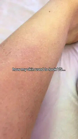 Thanks to my exfoliating kit with Black Beldi soap and Kessa glove. #fyp #skincare #naturalskincare #skintok #bodycareviral 