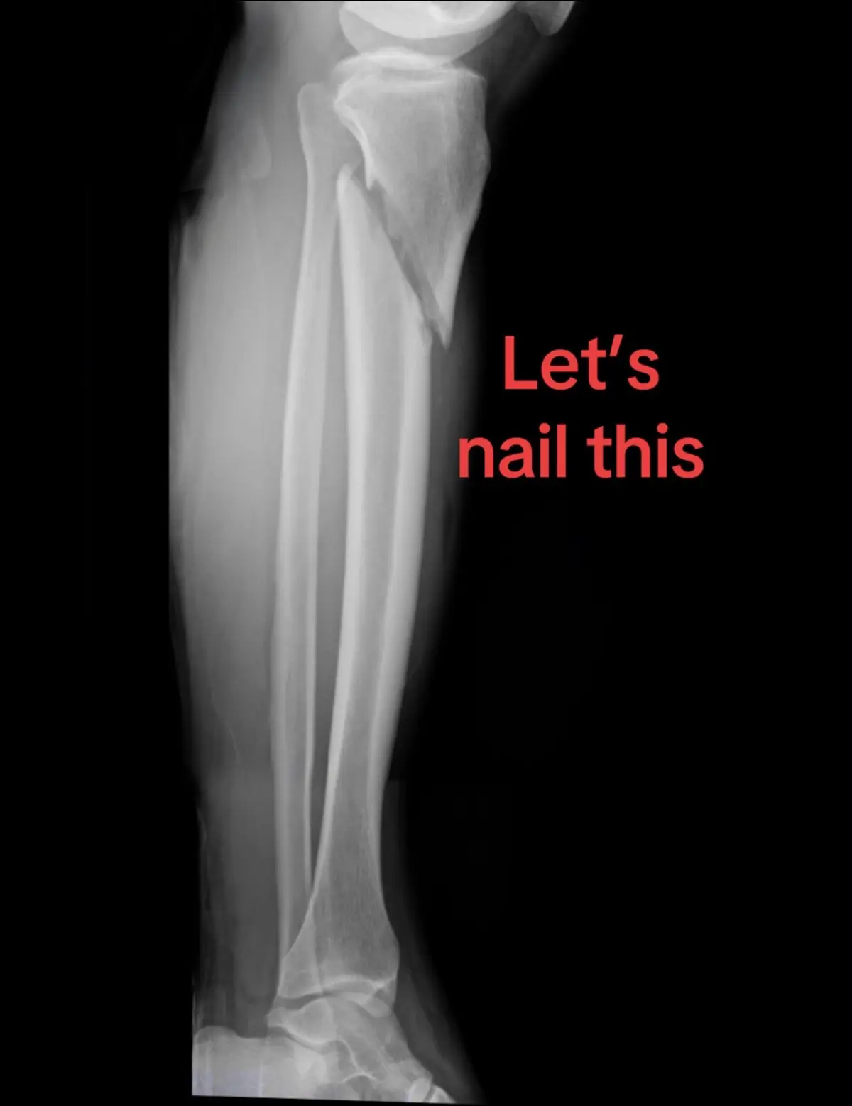 Why a nail? Because it’s much more stable than a plate, minimally invasive, and allows for immediate weightbearing.  These like to go into valgus and procurvatum.  To avoid that, some technical tips are: ⭐️Semi extended position ⭐️Suprapatellar nailing  ⭐️Reduction clamps to reduce the fracture  ⭐️A more lateral start point ⭐️A more posterior start point (and aim anterior, not posterior) ⭐️Blocking screws (lateral and posterior in proximal segment) ⭐️Uni cortical plates Remember to allow immediate weightbearing! Used with patient permission  #orthotrauma #orthopaedics #orthopedics #tibia #fracture  