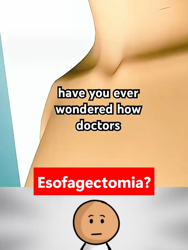 Eles Tiraram o Esôfago e Fizeram um Novo com o Estômago! 🤯  #cirurgia #esofagectomia #cancerdeesofago #estudiantedemedicina #curiosidade #3danimation #vocesabia