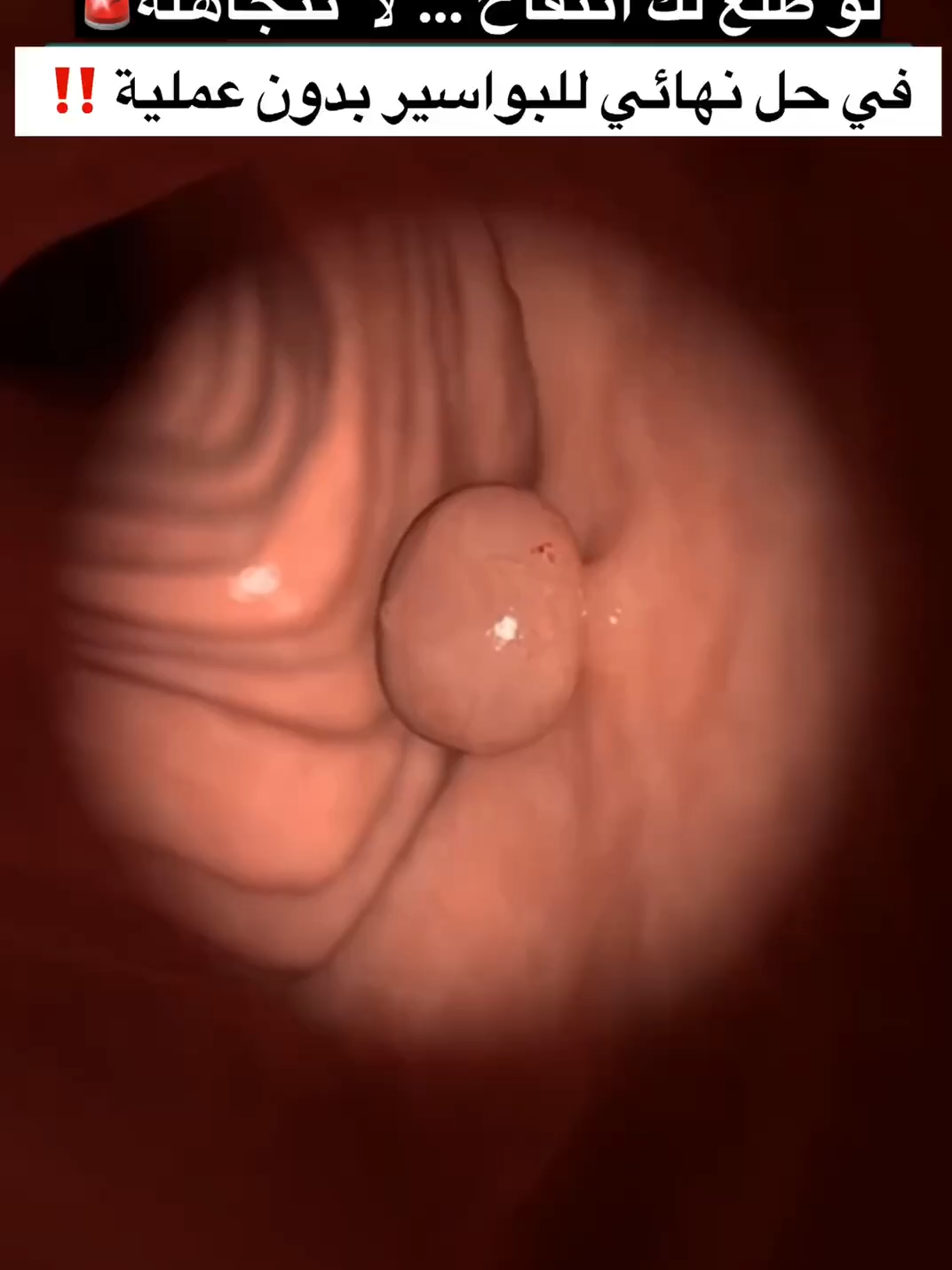 #بواسير #البواسير #البواسير_الخارجية #البواسيرالداخلية #الشرخ_الشرجي #الناسور_الشرجي #الرياض #السعودية🇸🇦 #السعودية #الشعب_الصيني_ماله_حل😂😂